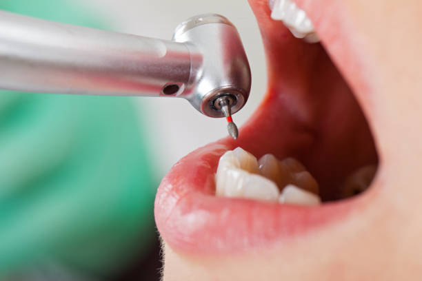 Best Emergency Broken Tooth Repair in Red Corral, CA